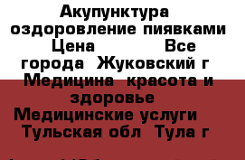 Акупунктура, оздоровление пиявками › Цена ­ 3 000 - Все города, Жуковский г. Медицина, красота и здоровье » Медицинские услуги   . Тульская обл.,Тула г.